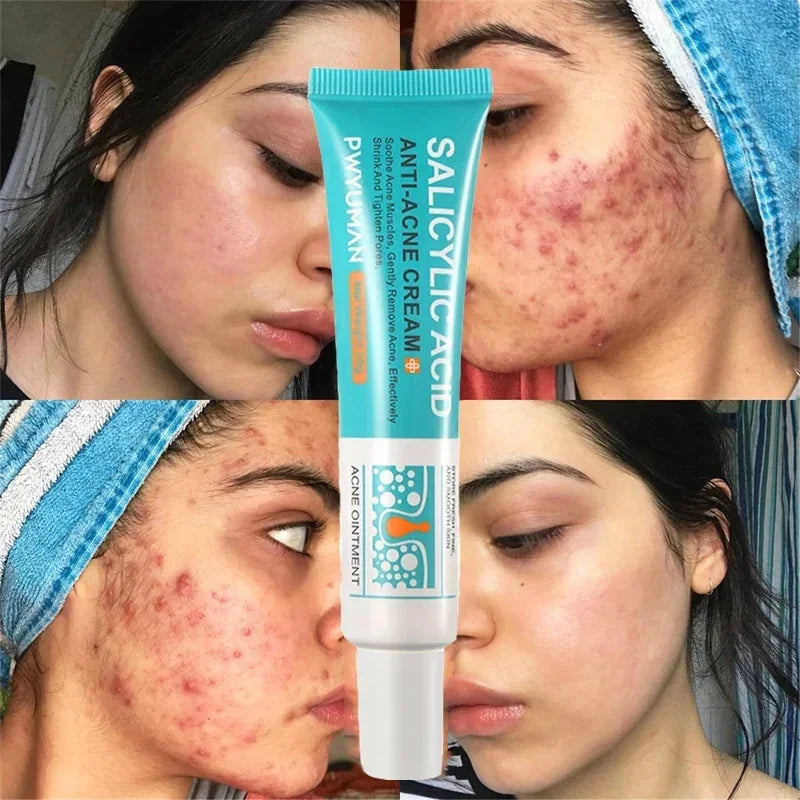 Acne Removal Cream Salicylic Acid Anti-Acne Fade Redness Pimple Scar Gel Shrink Pore Whitening Moisturizing Facial Skin Care 30G