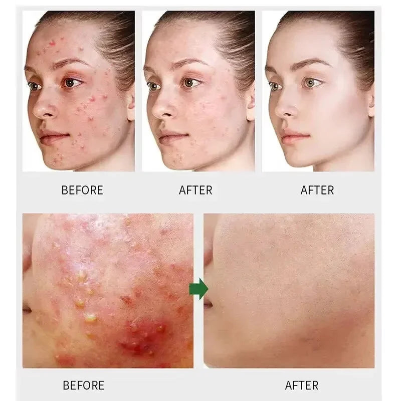 Acne Removal Cream Salicylic Acid Anti-Acne Fade Redness Pimple Scar Gel Shrink Pore Whitening Moisturizing Facial Skin Care 30G