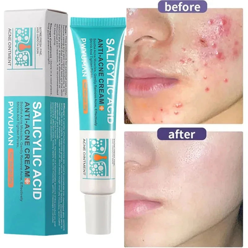 Acne Removal Cream Salicylic Acid Anti-Acne Fade Redness Pimple Scar Gel Shrink Pore Whitening Moisturizing Facial Skin Care 30G