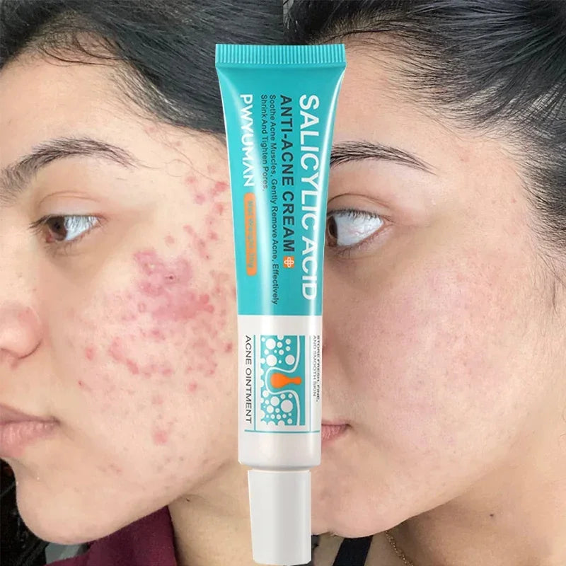 Acne Removal Cream Salicylic Acid Anti-Acne Fade Redness Pimple Scar Gel Shrink Pore Whitening Moisturizing Facial Skin Care 30G