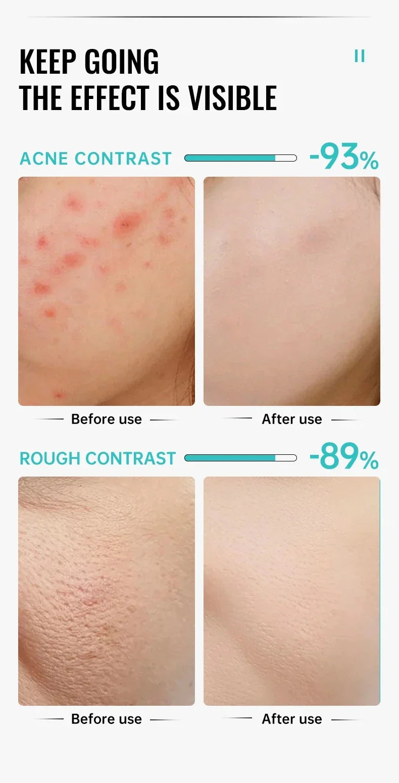 Acne Removal Cream Salicylic Acid Anti-Acne Fade Redness Pimple Scar Gel Shrink Pore Whitening Moisturizing Facial Skin Care 30G