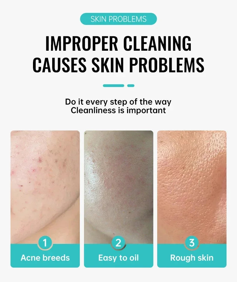 Acne Removal Cream Salicylic Acid Anti-Acne Fade Redness Pimple Scar Gel Shrink Pore Whitening Moisturizing Facial Skin Care 30G