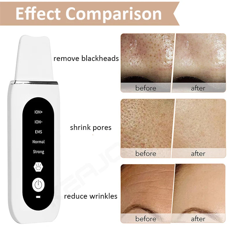 Ultrasonic Skin Scrubber Peeling Acne Blackhead Remover Ultrasonic EMS Ion Acne Pore Face Deep Cleaning Facial Shovel Cleaner