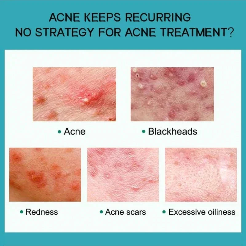 Acne Removal Cream Salicylic Acid Anti-Acne Fade Redness Pimple Scar Gel Shrink Pore Whitening Moisturizing Facial Skin Care 30G