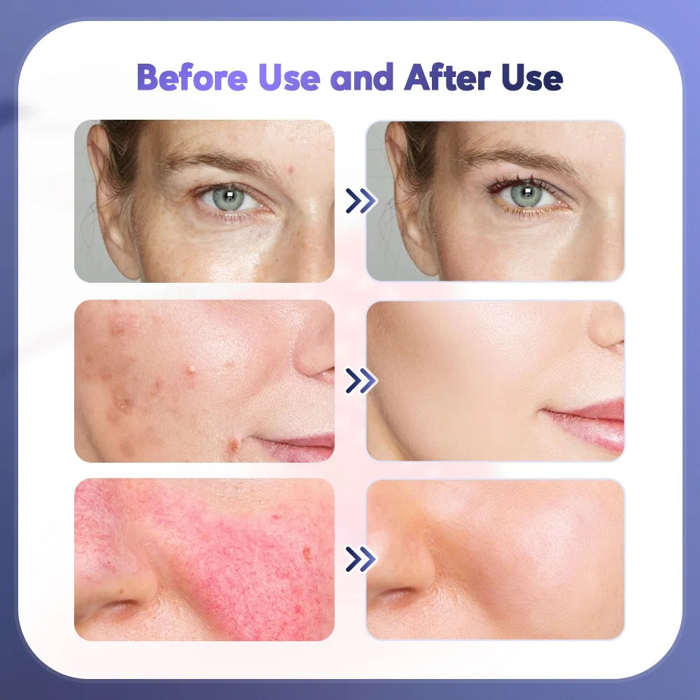 Foreverlily Facial Beauty Massager Skin Lifting Brightening Body Machine