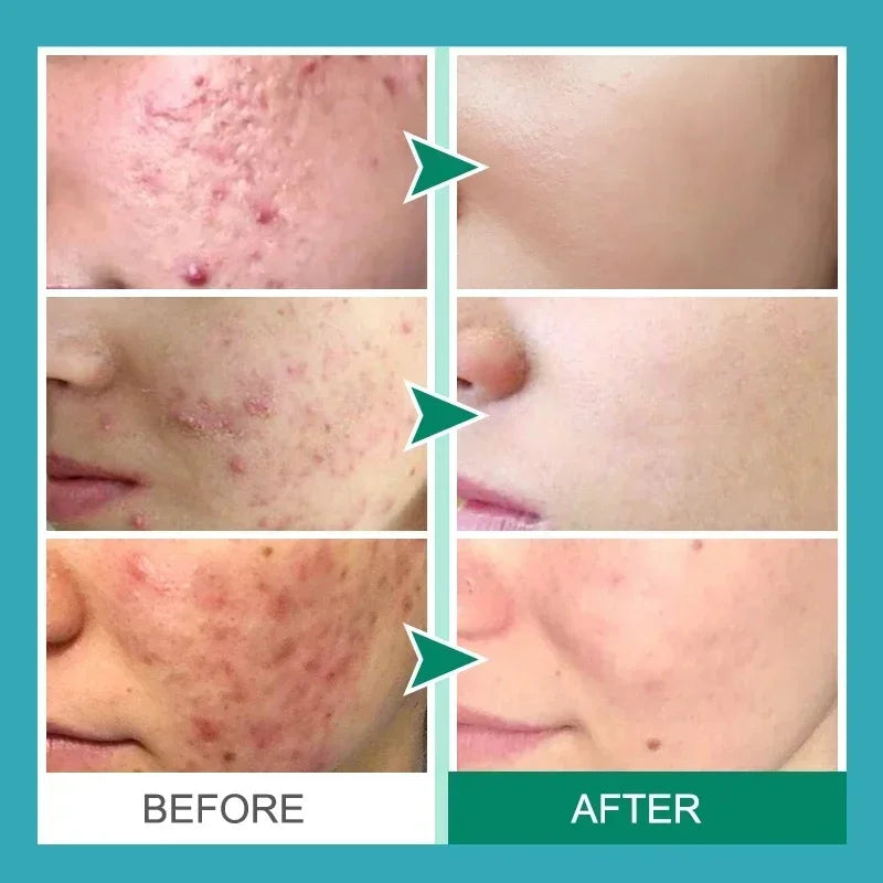 Acne Removal Cream Salicylic Acid Anti-Acne Fade Redness Pimple Scar Gel Shrink Pore Whitening Moisturizing Facial Skin Care 30G