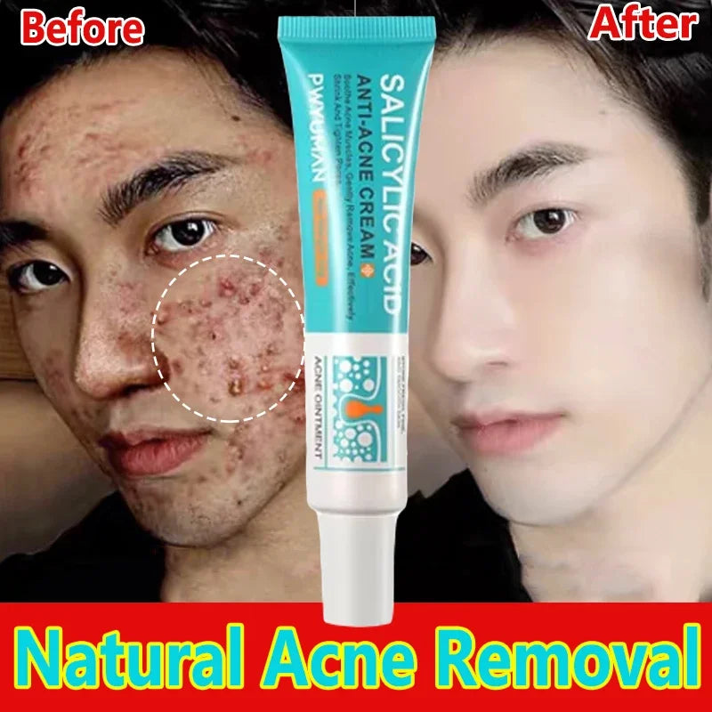 Acne Removal Cream Salicylic Acid Anti-Acne Fade Redness Pimple Scar Gel Shrink Pore Whitening Moisturizing Facial Skin Care 30G