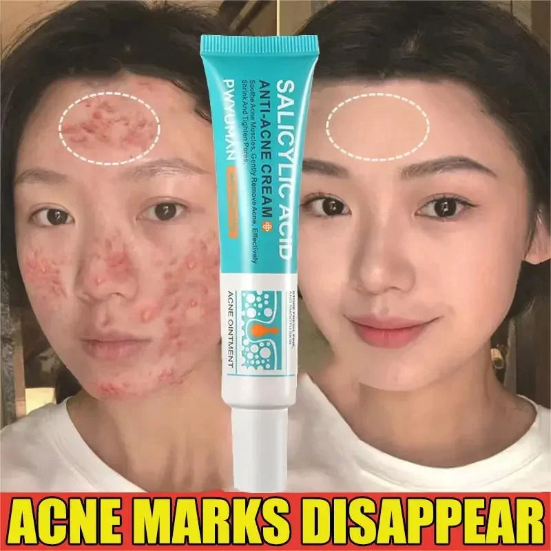 Acne Removal Cream Salicylic Acid Anti-Acne Fade Redness Pimple Scar Gel Shrink Pore Whitening Moisturizing Facial Skin Care 30G