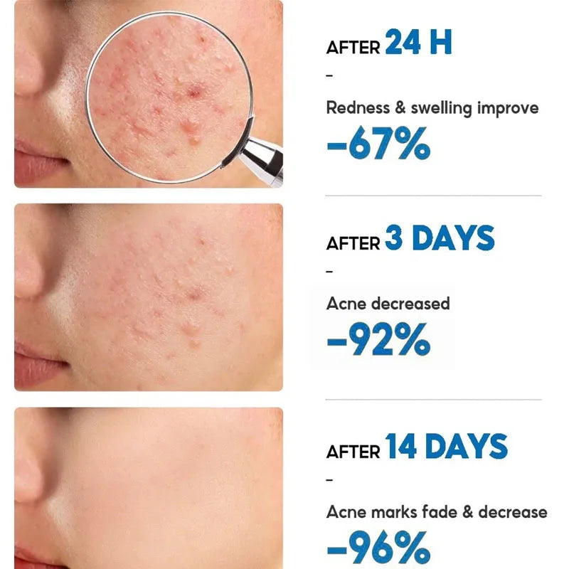 Acne Removal Cream Salicylic Acid Anti-Acne Fade Redness Pimple Scar Gel Shrink Pore Whitening Moisturizing Facial Skin Care 30G