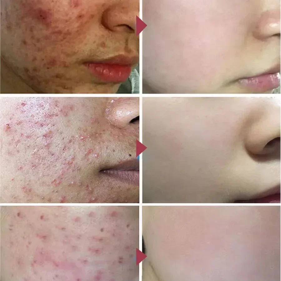 Acne Removal Cream Salicylic Acid Anti-Acne Fade Redness Pimple Scar Gel Shrink Pore Whitening Moisturizing Facial Skin Care 30G