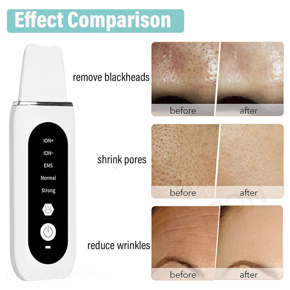 Ultrasonic Skin Scrubber Peeling Acne Blackhead Remover Ultrasonic EMS Ion Acne Pore Face Deep Cleaning Facial Shovel Cleaner