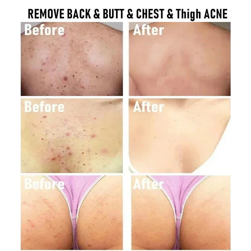 Acne Removal Cream Salicylic Acid Anti-Acne Fade Redness Pimple Scar Gel Shrink Pore Whitening Moisturizing Facial Skin Care 30G