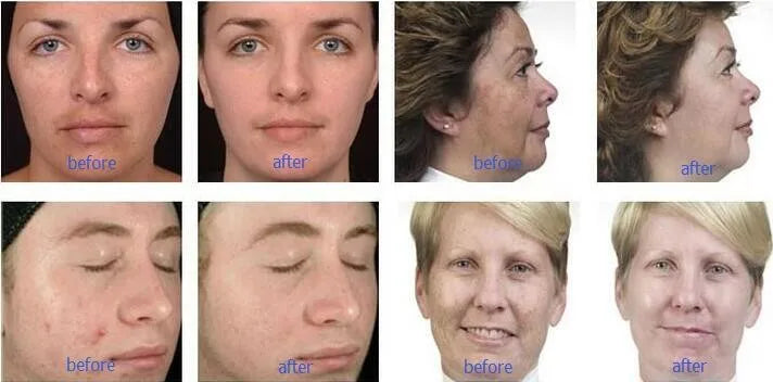 9 In 1 Hydra Professional Machine Aqua Facial Device New Beauty Health Korea Solution Aquaskin Smart Multifunction Oxygen Jet