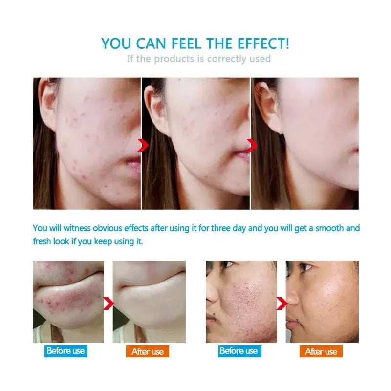 Acne Removal Cream Salicylic Acid Anti-Acne Fade Redness Pimple Scar Gel Shrink Pore Whitening Moisturizing Facial Skin Care 30G